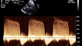 Echocardiogram With Mild Aortic Insufficiency [upl. by Gerstein]