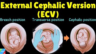 External Cephalic Version ECV  When is it used and how is it done [upl. by Roselle]