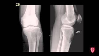 Radiology Boards Prep  MSK Cases [upl. by Thorin782]