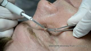 Soft fibroma  removal by highfrequency electrosurgery [upl. by Cottrell124]