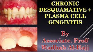 12Periodontal diseases2DesquamativePlasma cell gingivitis Wadhah Periodontology lecturesدوضاح [upl. by Wilmar848]