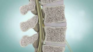 Spinal Stenosis and Spine Surgery  Medical Animation [upl. by Ybbob]