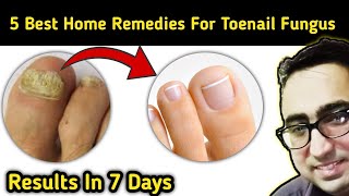 Top 5 Remedies To Cure Nail Fungus Just In 7 Days At Home  Pharmacist Javaid [upl. by Adile]