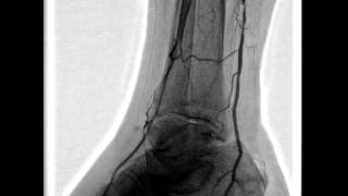 Balloon angioplasty of the femoral artery [upl. by Pelagi348]