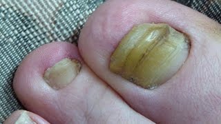 Toenail Fungus Cured 2 Years Progress [upl. by Lyndel]