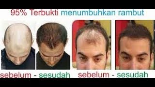 TERBUKTI 10 Cara Menumbuhkan Rambut Botak dengan Cepat Secara Alami [upl. by Mori]