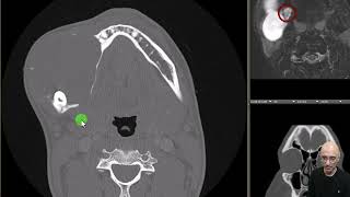 Ameloblastoma [upl. by Seraphina917]