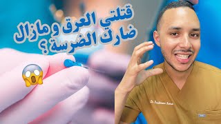 قتلتي العرق و مازال ضارك الضرسة ؟واش عادي أو لا؟ [upl. by Cecily345]