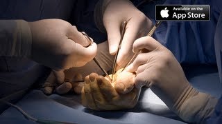 Carpal Tunnel Surgery [upl. by Pattin]