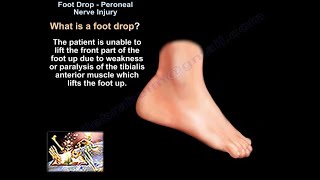 Foot Drop Peroneal Nerve Injury  Everything You Need To Know  Dr Nabil Ebraheim [upl. by Cristen]