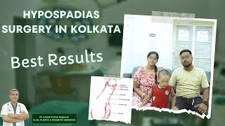 Hypospadias Surgery In Kolkata  Hypospadias Problem amp Solution  Best Result [upl. by Anirhtak]