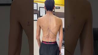 Different types of scoliosis treated byDrRavi scoliosistreatment chiropractic chiro spine short [upl. by Nimesh]