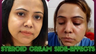 Treatment of Steroid Cream Side Effects and How To Bring back you original Skin Tone [upl. by Laehplar595]