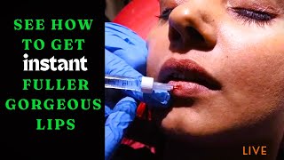 See How To Get Fuller GORGEOUS Lips Instantly With Juvederm Lip Filler lipaugmentation lipfiller [upl. by Oberg]