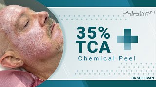 TCA Chemical Peel Unveiled Transform Your Skin Today chemicalpeels tcapeel acne wrinkles [upl. by Aphrodite]