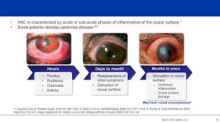 Understanding Vernal Keratoconjunctivitis VKC Not “Just an Allergy” [upl. by Zanze525]