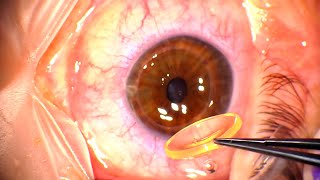 Corneal Transplant Penetrating Keratoplasty for Advanced Keratoconus and Corneal Infiltrates [upl. by Ginder]