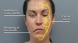 Understanding Facial Palsy [upl. by Phillips213]