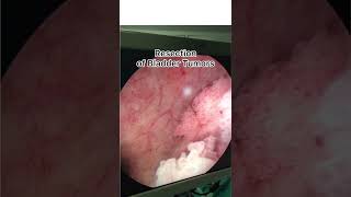 Endoscopic Removal of Bladder Tumor [upl. by Linkoski]