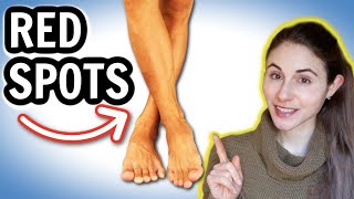 Why you get RED SPOTS ON THE LEGS amp HOW TO GET RID OF THEM  Dermatologist DrDrayzday [upl. by Rausch]