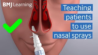 Teaching patients to use nasal sprays  BMJ Learning [upl. by Okihcim]