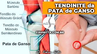 JOELHO TENDINITE DA PATA DE GANSO CAUSAS E TRATAMENTO DE FISIOTERAPIA Dr Robson Sitta [upl. by Hanako]