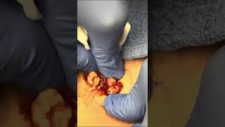 Back Cyst Pop  Dr Derm [upl. by Fried]