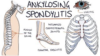 Ankylosing Spondylitis Visual Explanation for Students [upl. by Leoj]