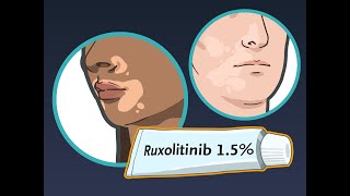 Ruxolitinib Cream for Vitiligo  NEJM [upl. by Slein]