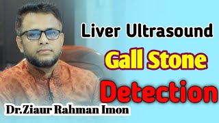 Liver Ultrasound Gall Stone Detection ULTRASOUND TV [upl. by Tahp209]