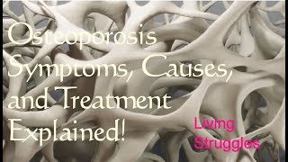 Osteoporosis Symptoms Causes and Treatment Explained [upl. by Einahpts]