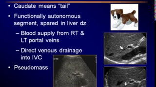 Sonography of the Liver [upl. by Grimaud]