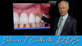 Abfraction on Tooth Colored Restorations  Dental Minute with Steven T Cutbirth DDS [upl. by Nahtnahoj498]