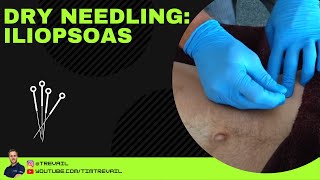 Dry Needling Iliopsoas [upl. by Barren812]