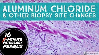 Aluminum Chloride Drysol Effect Recognize a Biopsy Site without Clinical History [upl. by Marlee]