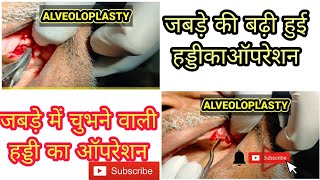 Alveoloplasty  bone removal surgerybony spicule removal in old patient draquil5454 [upl. by Aleel]