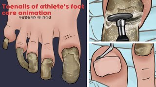 ASMR Satisfying Toenail of Athletes foot Treatment animation  Athletes foot foot care  TINGLES [upl. by Leonanie487]