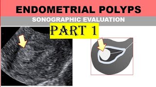 Endometrial Polyps sonographic evaluation [upl. by Oetam57]