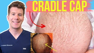 Doctor explains CRADLE CAP Seborrheic dermatitis in babies amp infants  Photos and home treatment [upl. by Devora]