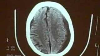 Subdural hematoma [upl. by Irolam578]