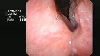 Cancer of the larynx voicebox  wwwdrjeevecom [upl. by Oriana]