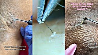 INGROWN HAIR REMOVAL COMPILATION [upl. by Rockey]