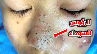 أفضل 3 طرق للتخلص نهائيا من الرؤوس السوداء والدهون الزائدة من الأنف والوجة Blackheads [upl. by Lev]