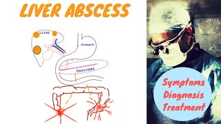 Liver Abscess [upl. by Auqinimod]