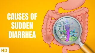 Causes of Sudden Diarrhea [upl. by Rushing]