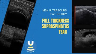 Full thickness Supraspinatus tendon tear on ultrasound [upl. by Ketchum]