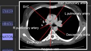 Approach to CT Chest 849 [upl. by Yesac]