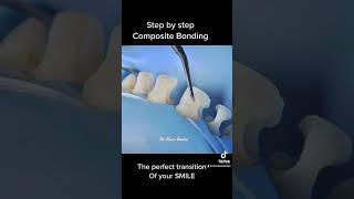 Teeth Composite bonding step by step [upl. by Glick]