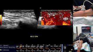 Ultrasoundguided nerve hydrodissection for pain management – Supplementary video 7 ID 247208 [upl. by Phenice]