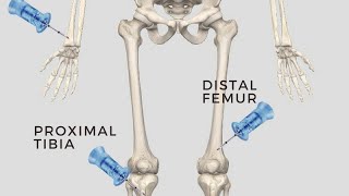 intraosseous Access in difficult canulation of children [upl. by Renrag]